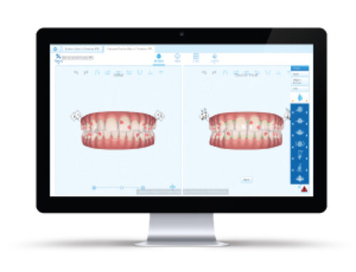 ClinCheck® software The digital road map to your new smile